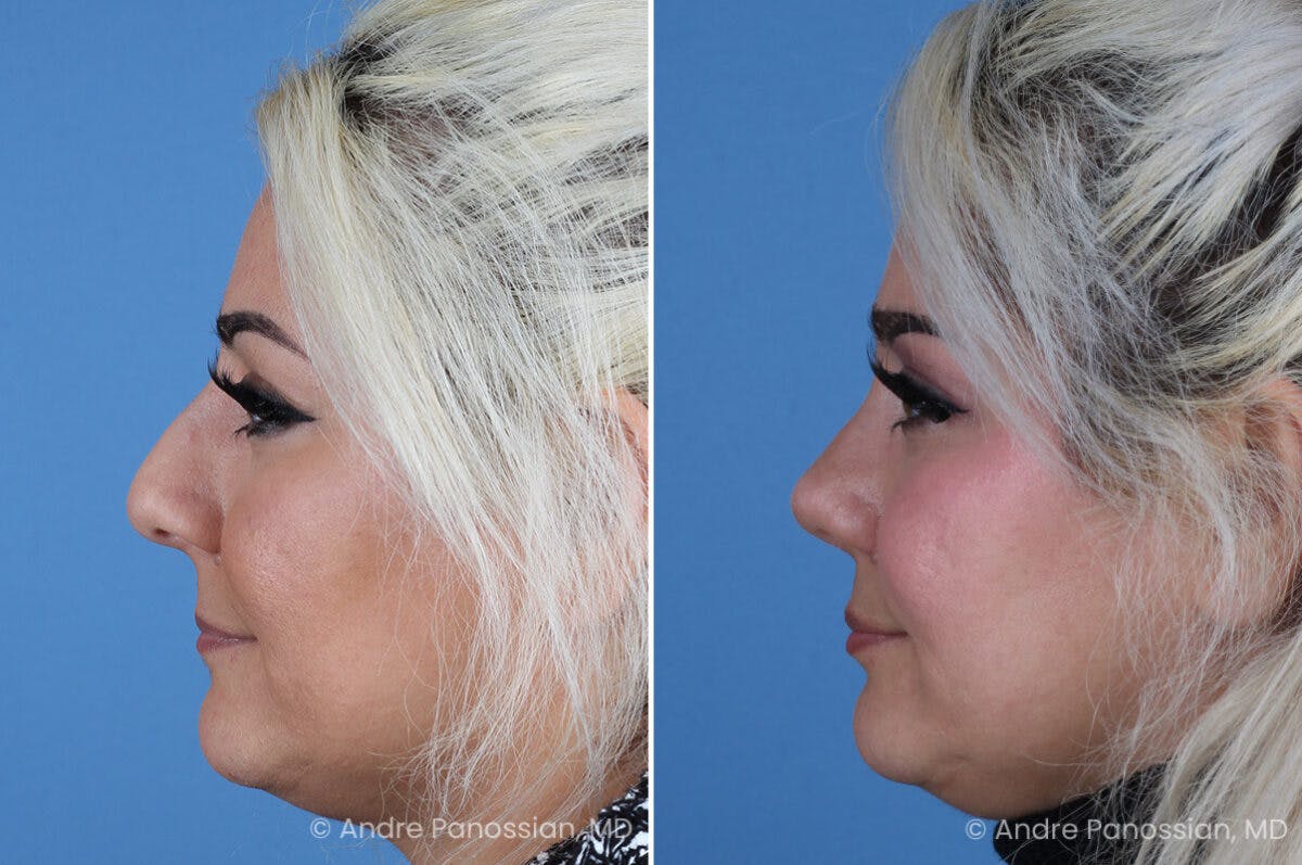 Rhinoplasty Before & After Gallery - Patient 912170 - Image 4