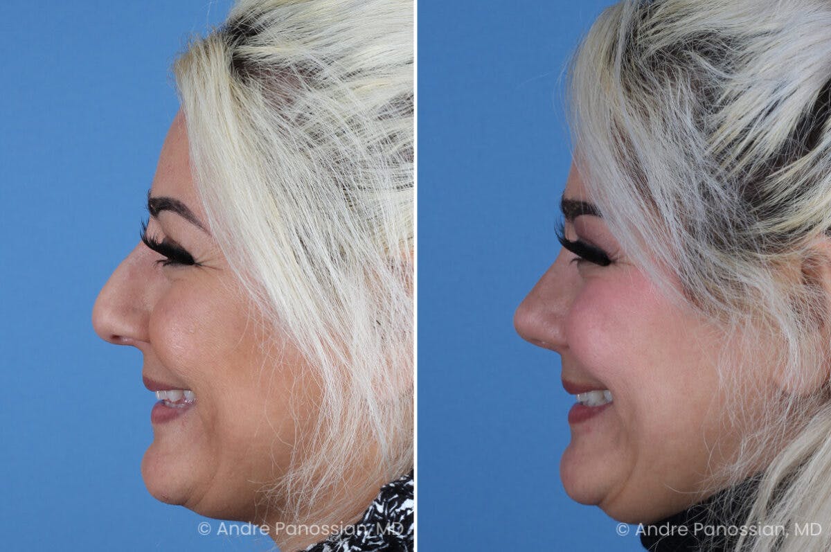 Rhinoplasty Before & After Gallery - Patient 912170 - Image 5