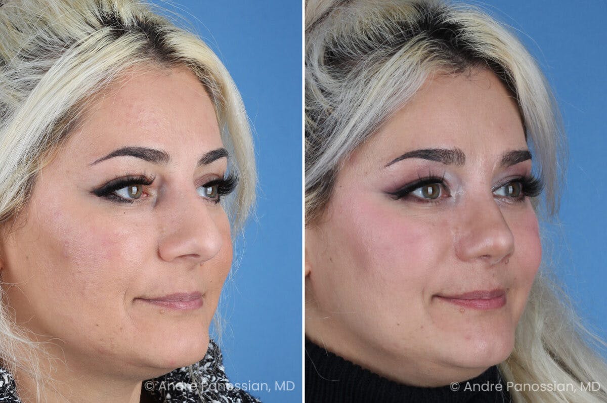 Rhinoplasty Before & After Gallery - Patient 912170 - Image 6