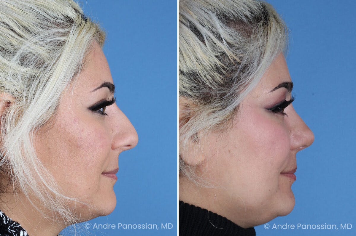Rhinoplasty Before & After Gallery - Patient 912170 - Image 1