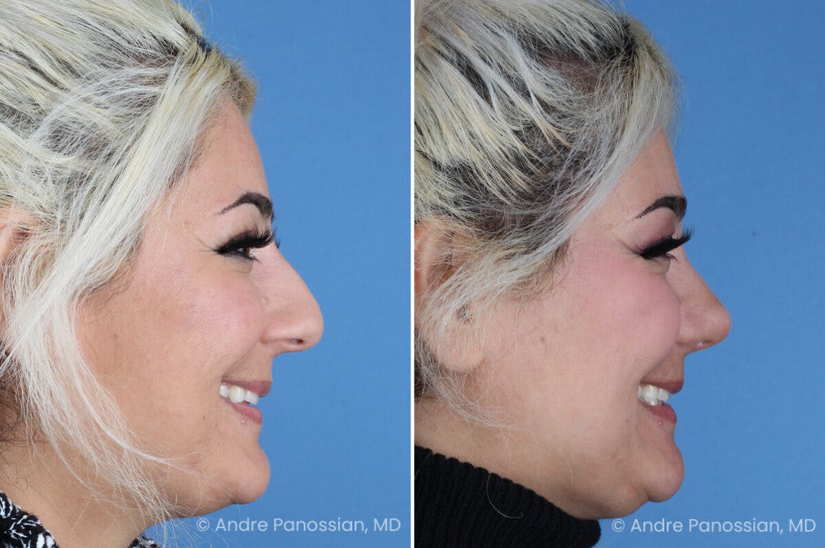 Rhinoplasty Before & After Gallery - Patient 912170 - Image 7