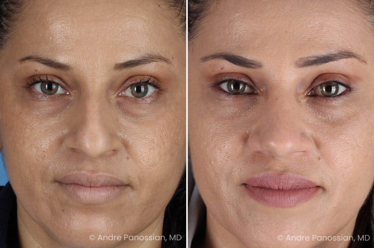 Rhinoplasty Before & After Gallery - Patient 252883 - Image 2