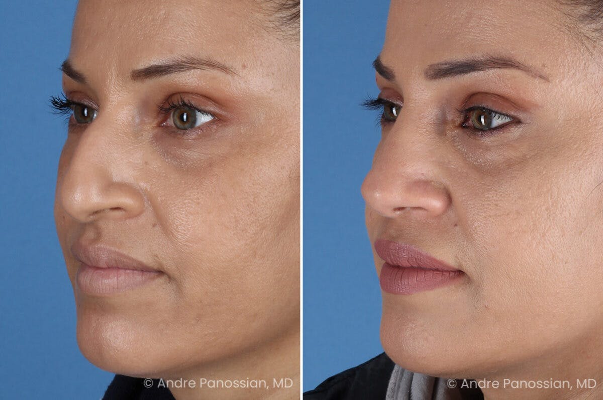 Rhinoplasty Before & After Gallery - Patient 252883 - Image 3