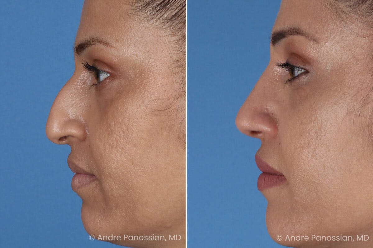 Rhinoplasty Before & After Gallery - Patient 252883 - Image 4