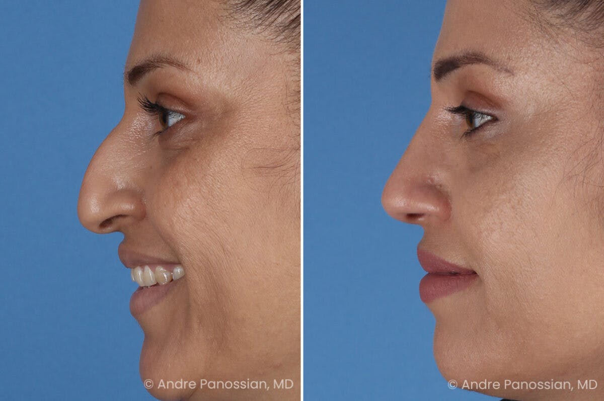Rhinoplasty Before & After Gallery - Patient 252883 - Image 5
