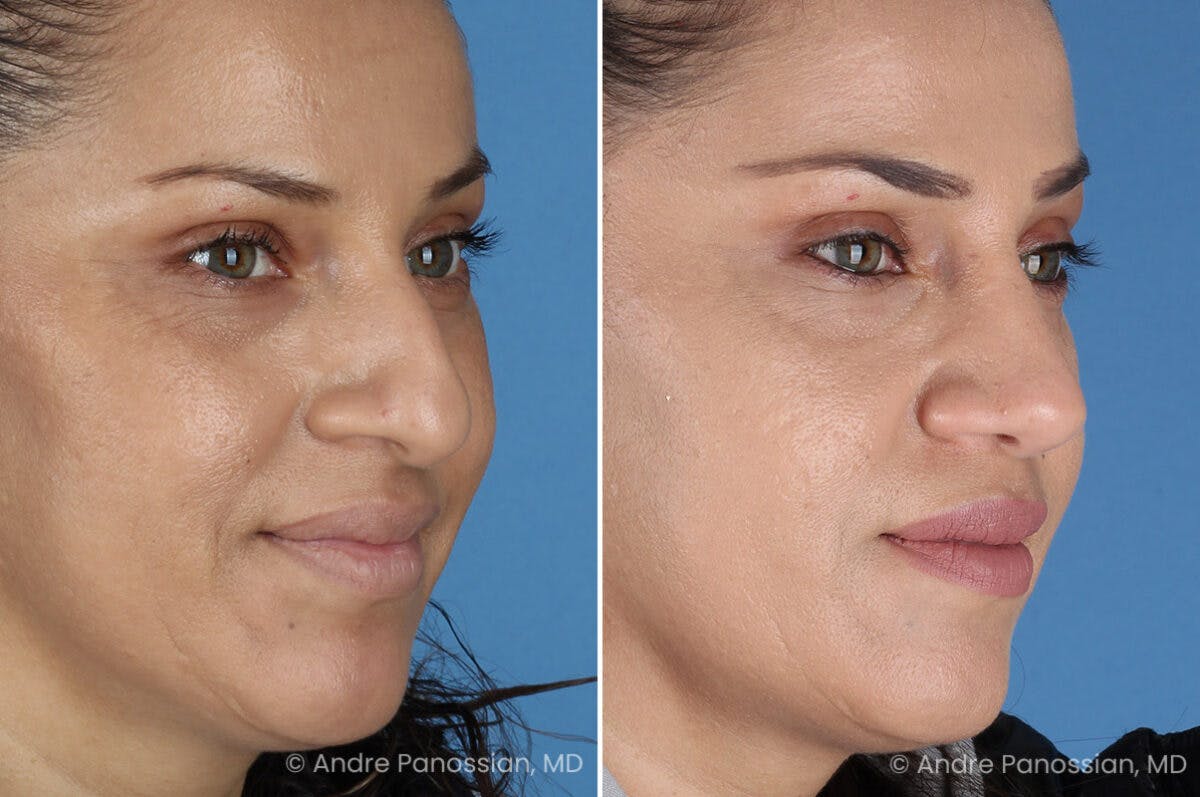 Rhinoplasty Before & After Gallery - Patient 252883 - Image 6