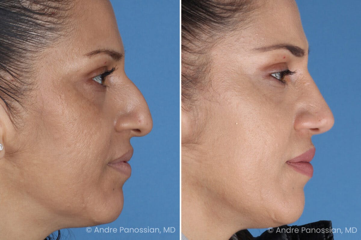 Rhinoplasty Before & After Gallery - Patient 252883 - Image 7
