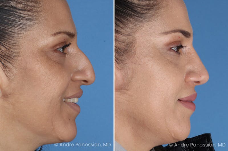 Rhinoplasty Before & After Gallery - Patient 252883 - Image 1