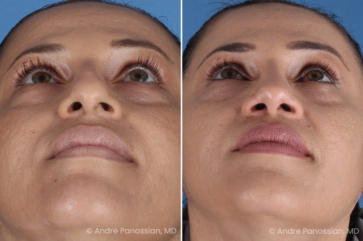 Rhinoplasty Before & After Gallery - Patient 252883 - Image 8