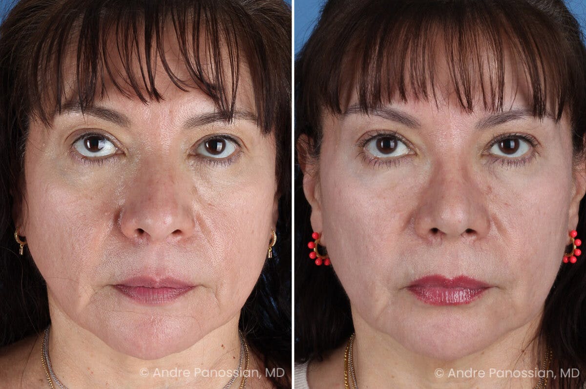 Rhinoplasty Before & After Gallery - Patient 417269 - Image 2