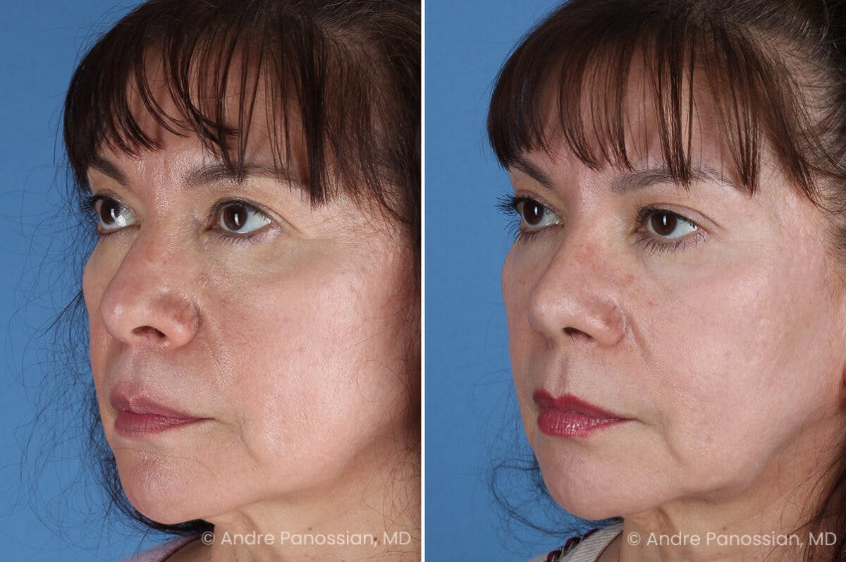 Rhinoplasty Before & After Gallery - Patient 417269 - Image 3