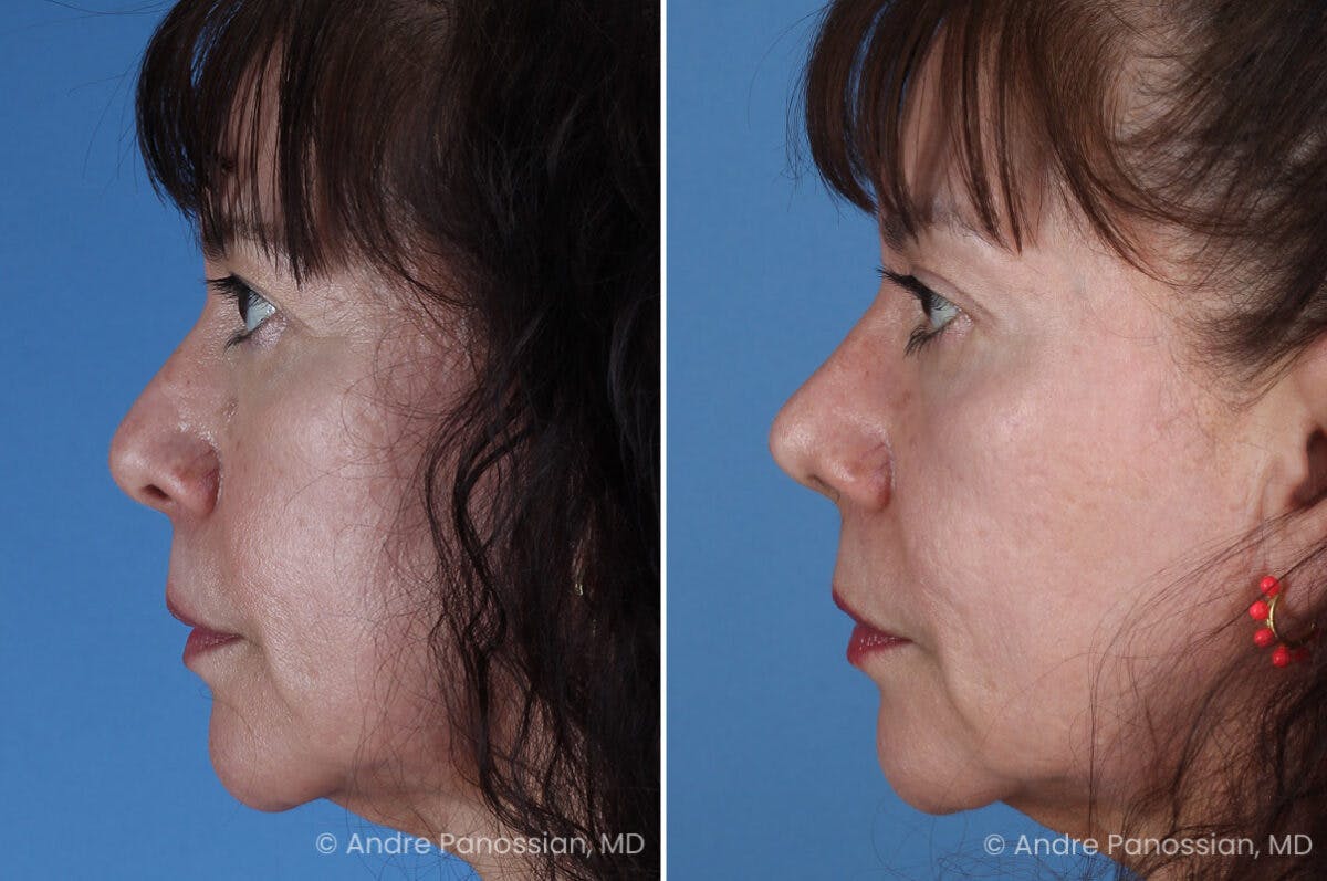 Rhinoplasty Before & After Gallery - Patient 417269 - Image 4