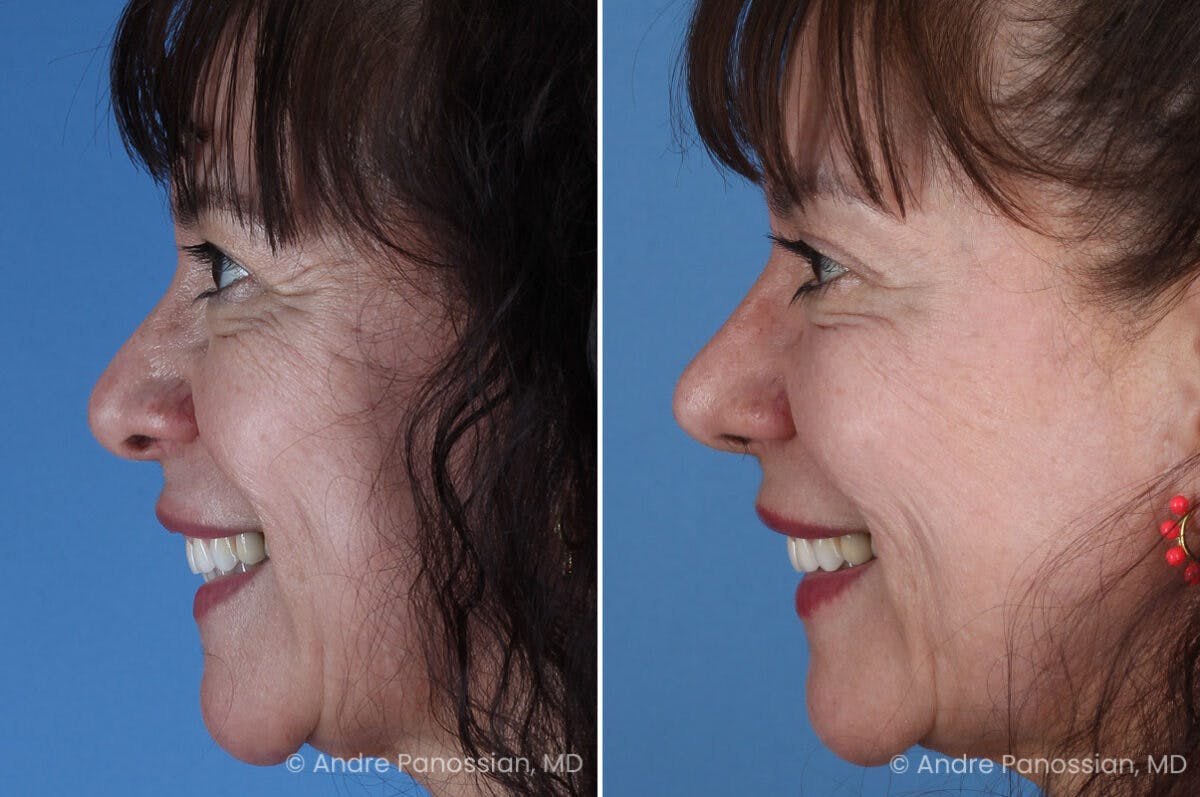 Rhinoplasty Before & After Gallery - Patient 417269 - Image 5