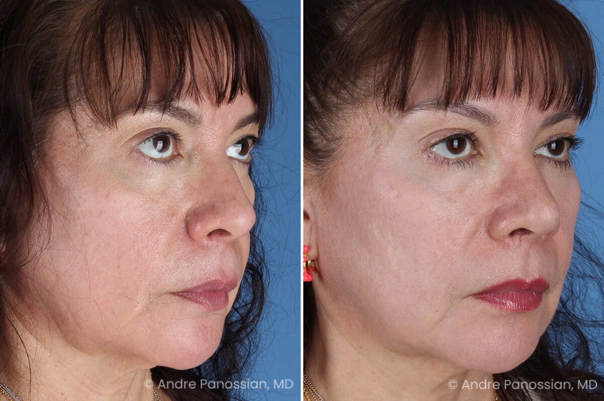 Rhinoplasty Before & After Gallery - Patient 417269 - Image 6