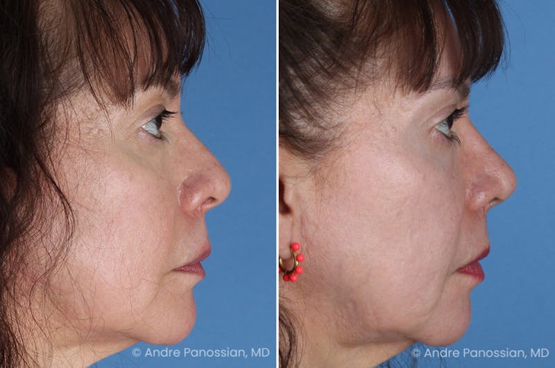 Rhinoplasty Before & After Gallery - Patient 417269 - Image 1