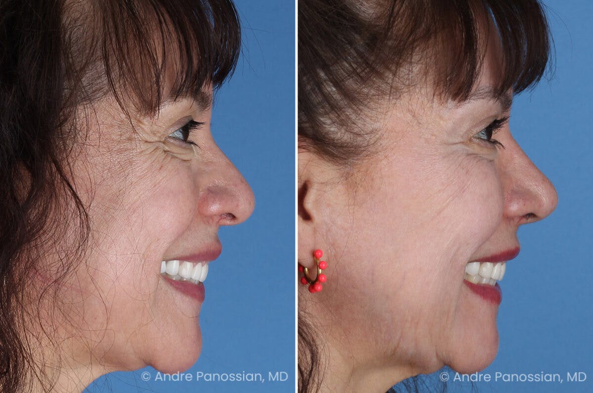Rhinoplasty Before & After Gallery - Patient 417269 - Image 7