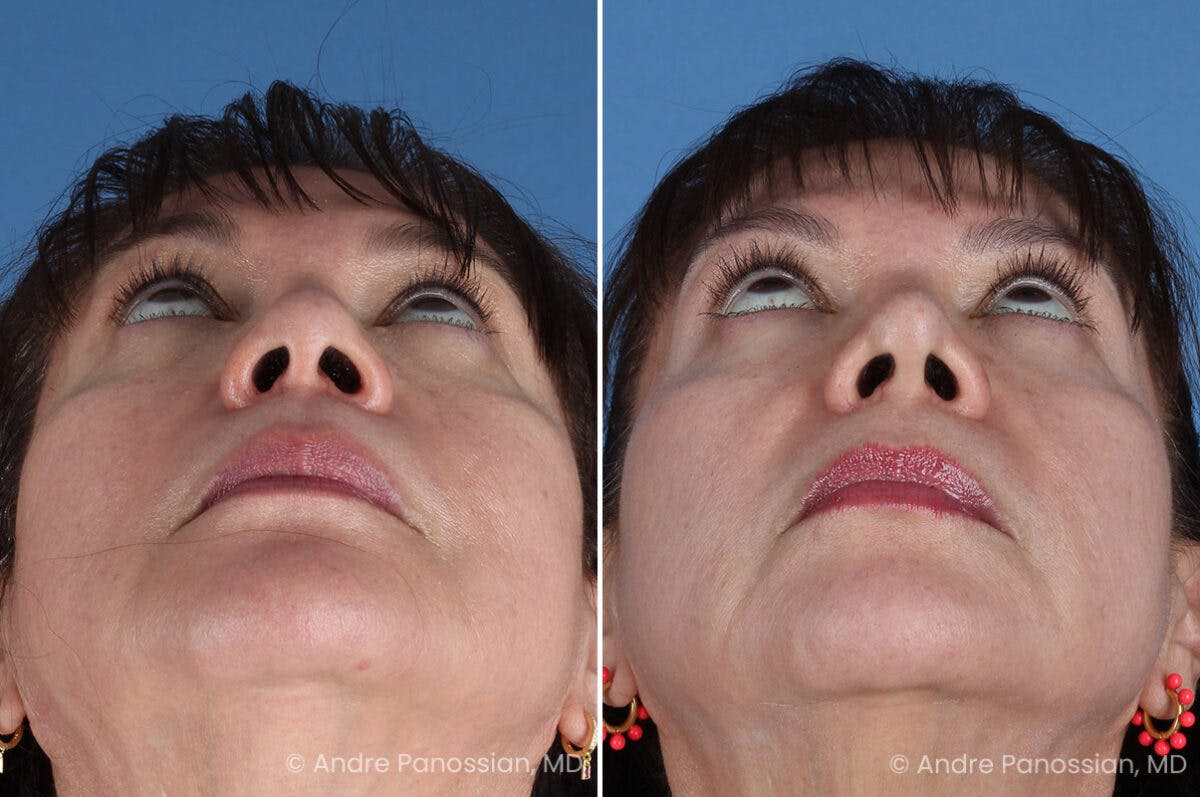 Rhinoplasty Before & After Gallery - Patient 417269 - Image 8