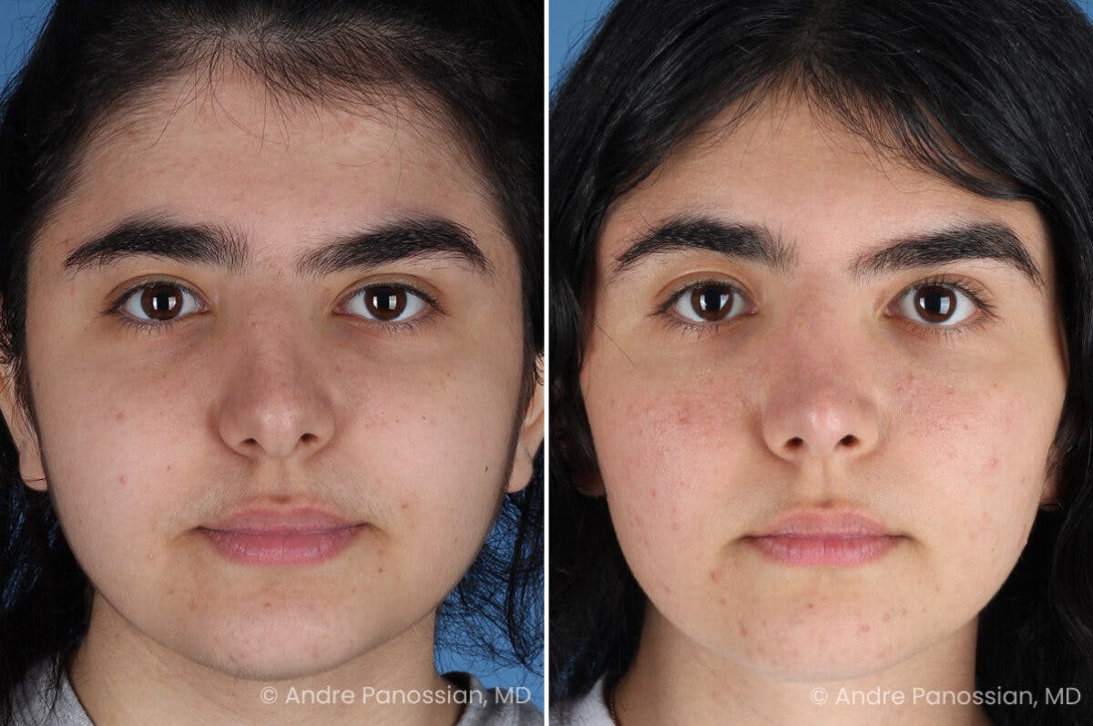 Rhinoplasty Before & After Gallery - Patient 186532 - Image 2
