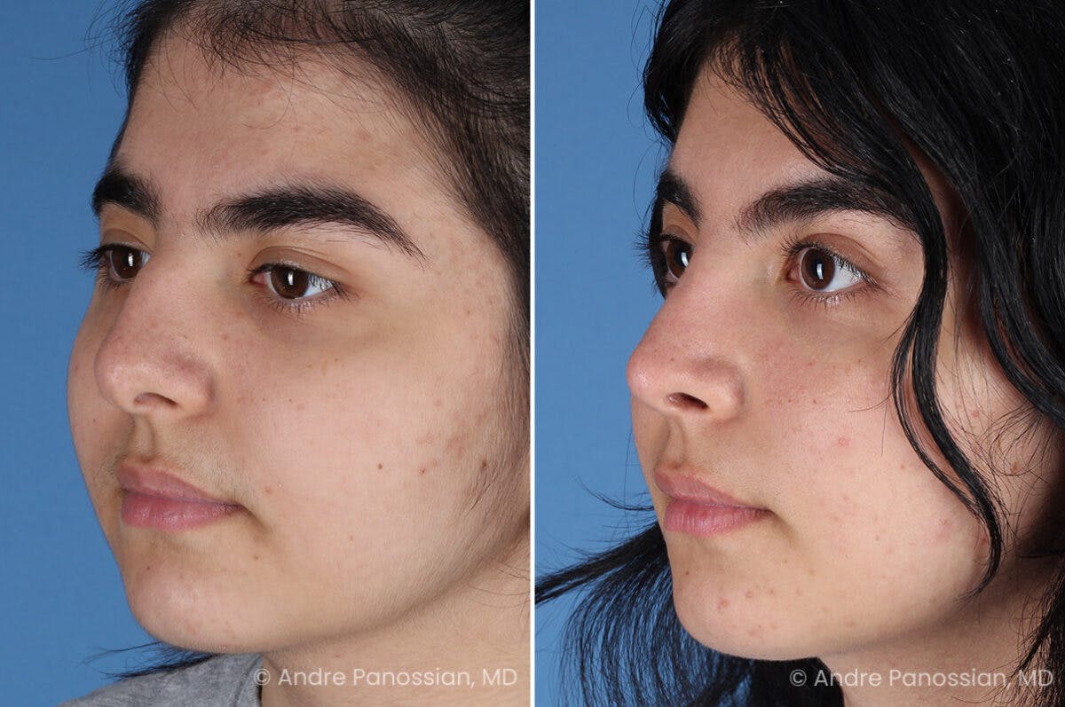 Rhinoplasty Before & After Gallery - Patient 186532 - Image 3