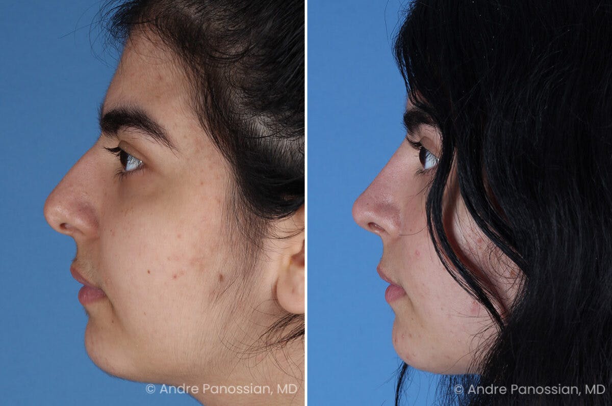 Rhinoplasty Before & After Gallery - Patient 186532 - Image 4