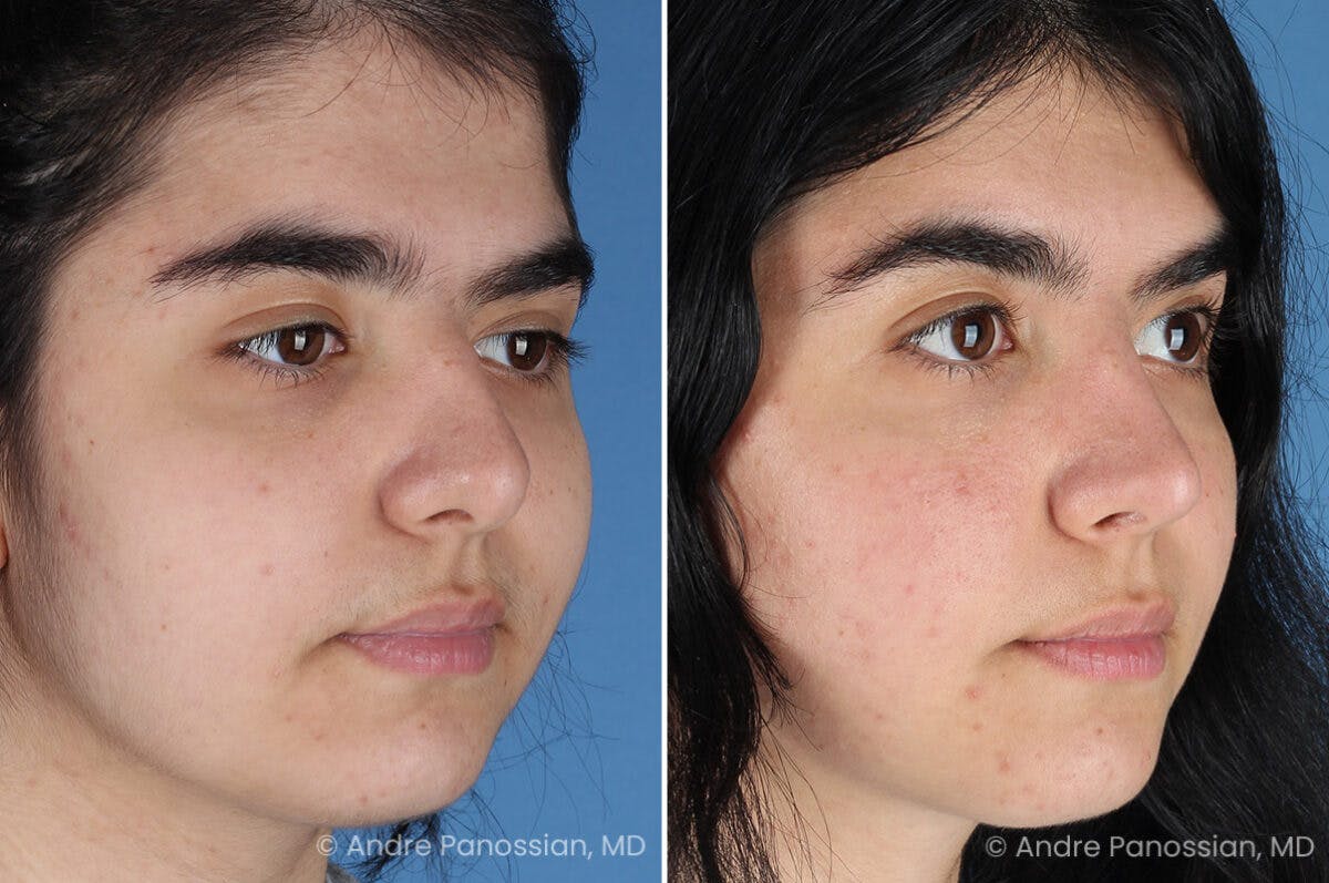 Rhinoplasty Before & After Gallery - Patient 186532 - Image 5