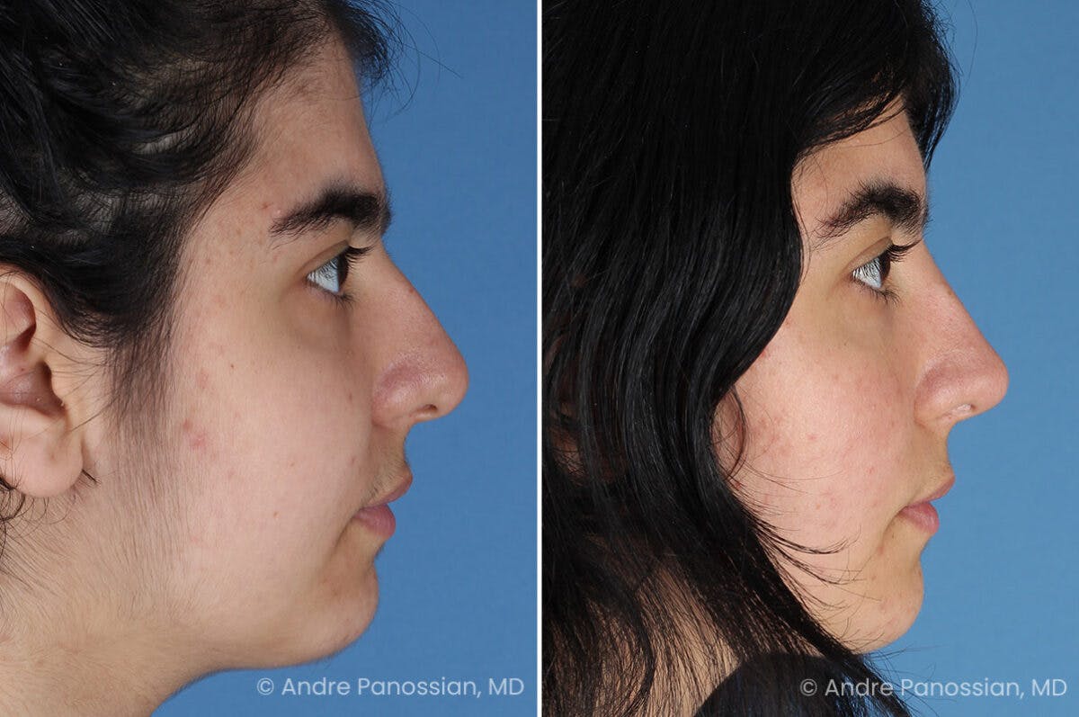 Rhinoplasty Before & After Gallery - Patient 186532 - Image 1