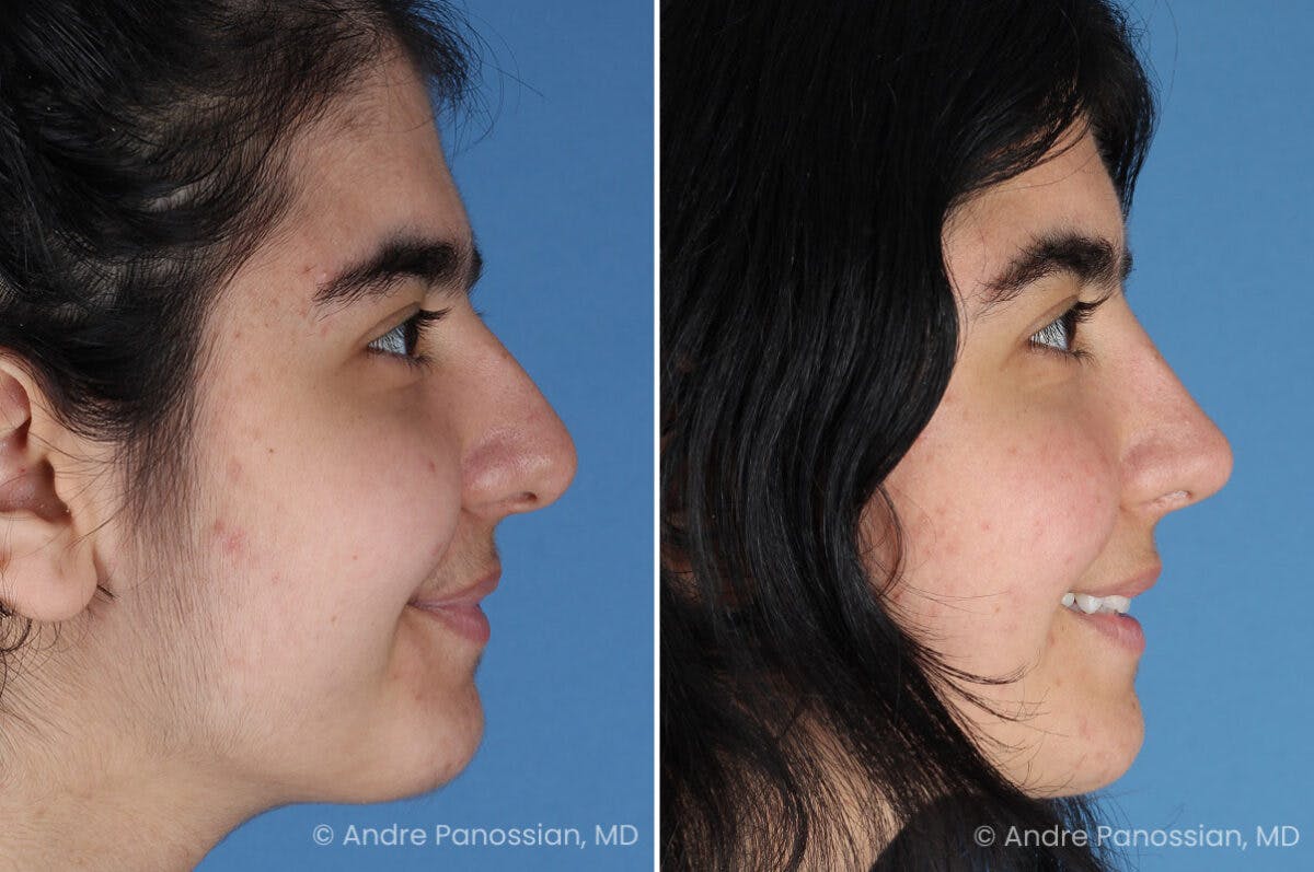 Rhinoplasty Before & After Gallery - Patient 186532 - Image 6