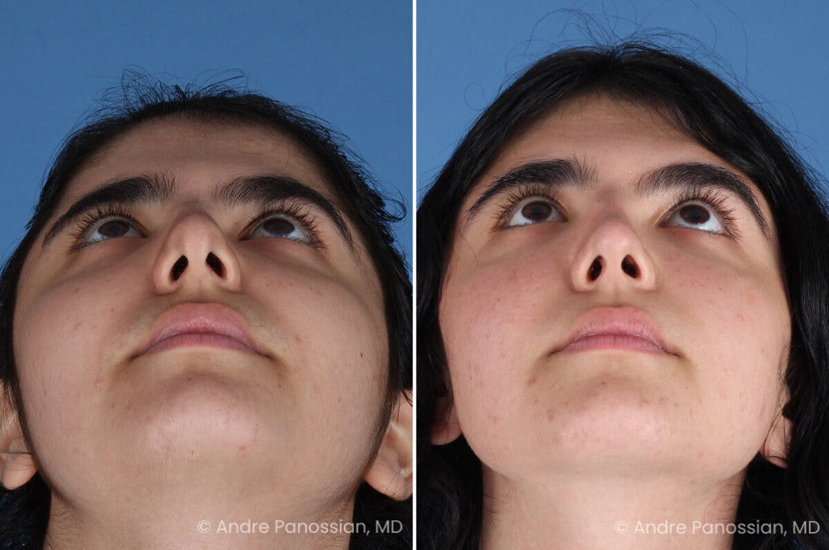 Rhinoplasty Before & After Gallery - Patient 186532 - Image 7