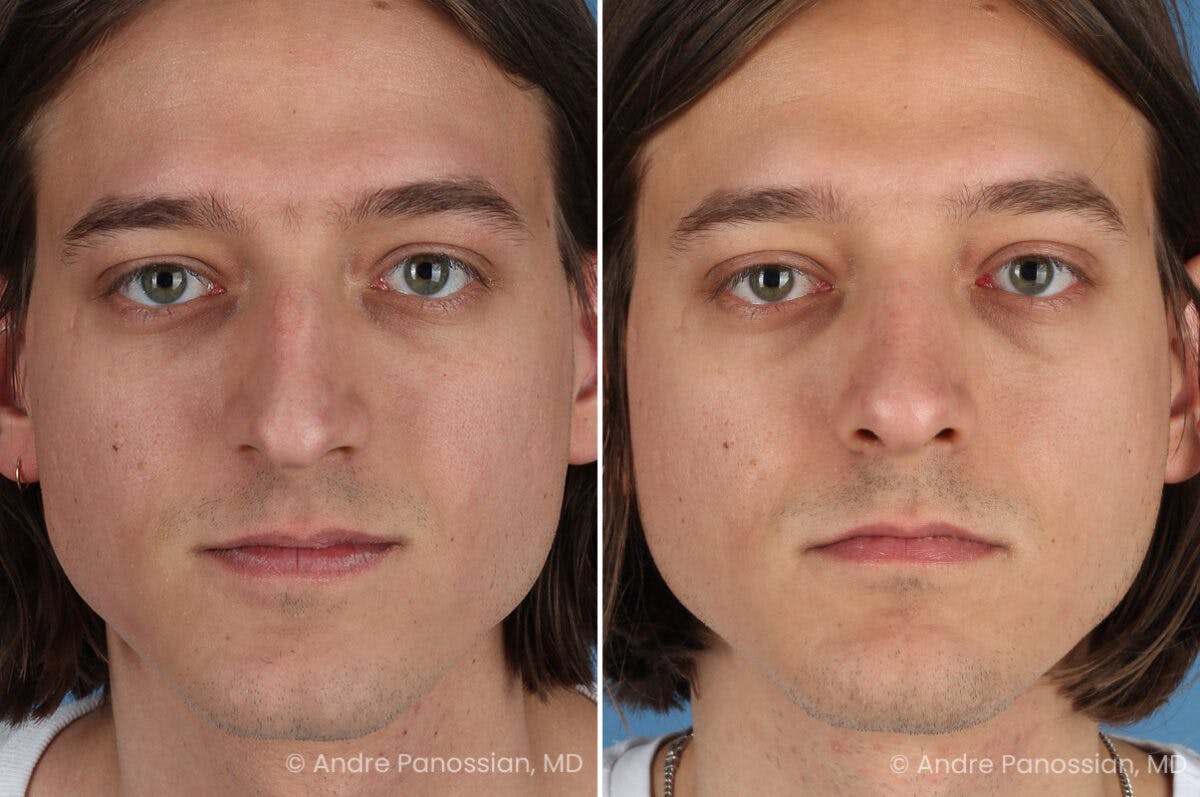 Rhinoplasty Before & After Gallery - Patient 163652 - Image 2