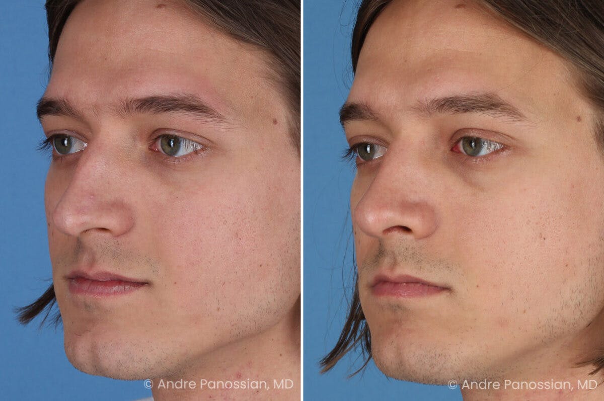 Rhinoplasty Before & After Gallery - Patient 163652 - Image 3