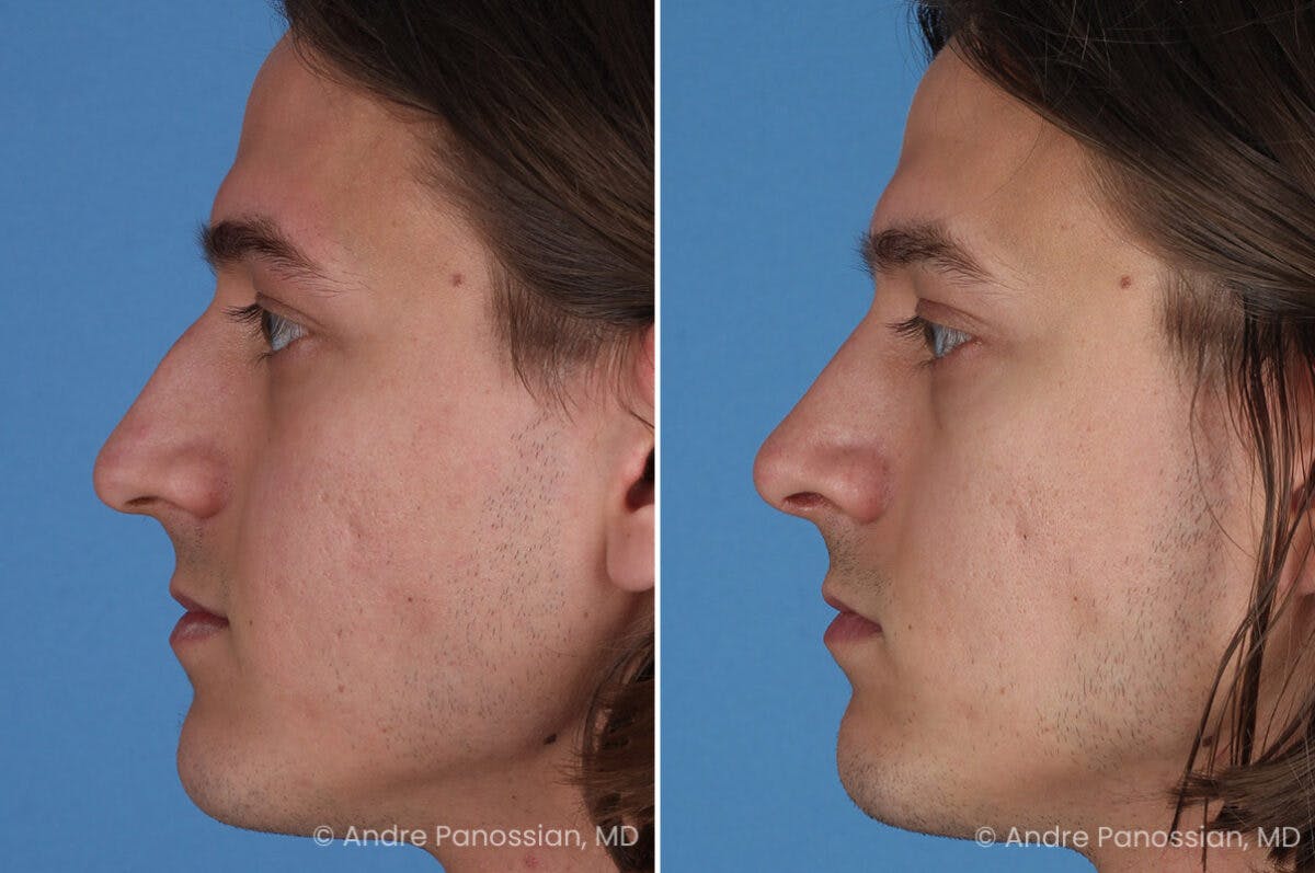 Rhinoplasty Before & After Gallery - Patient 163652 - Image 4
