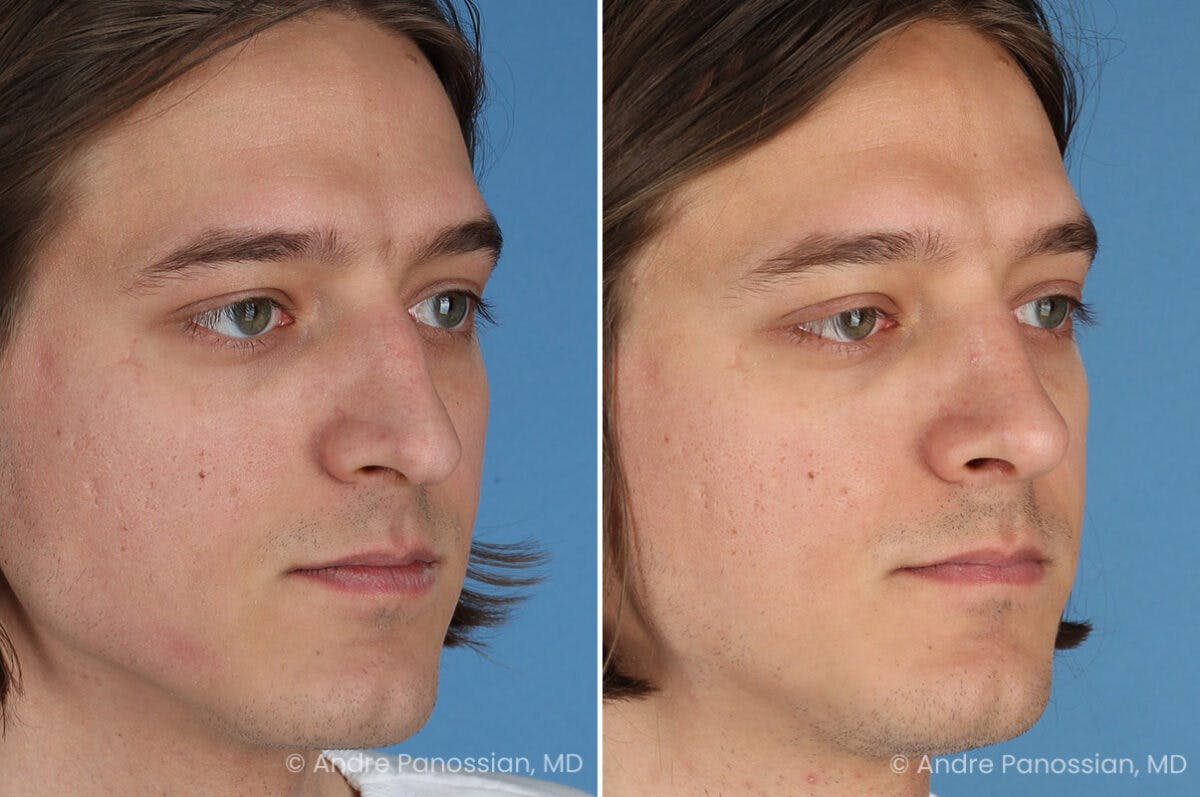 Rhinoplasty Before & After Gallery - Patient 163652 - Image 6
