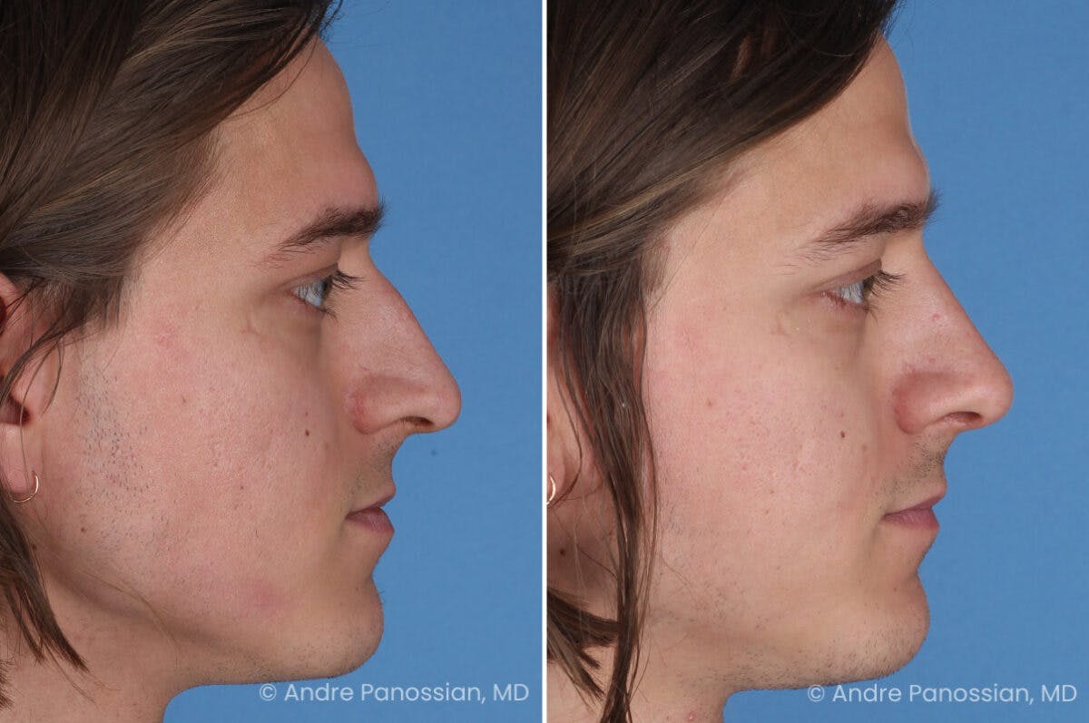 Rhinoplasty Before & After Gallery - Patient 163652 - Image 1