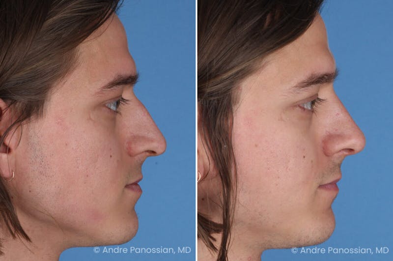 Rhinoplasty Before & After Gallery - Patient 163652 - Image 1