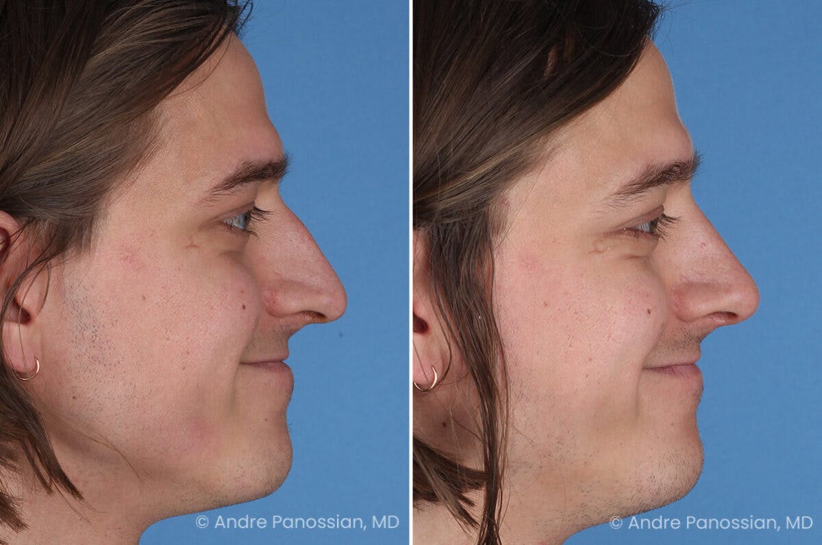 Rhinoplasty Before & After Gallery - Patient 163652 - Image 7
