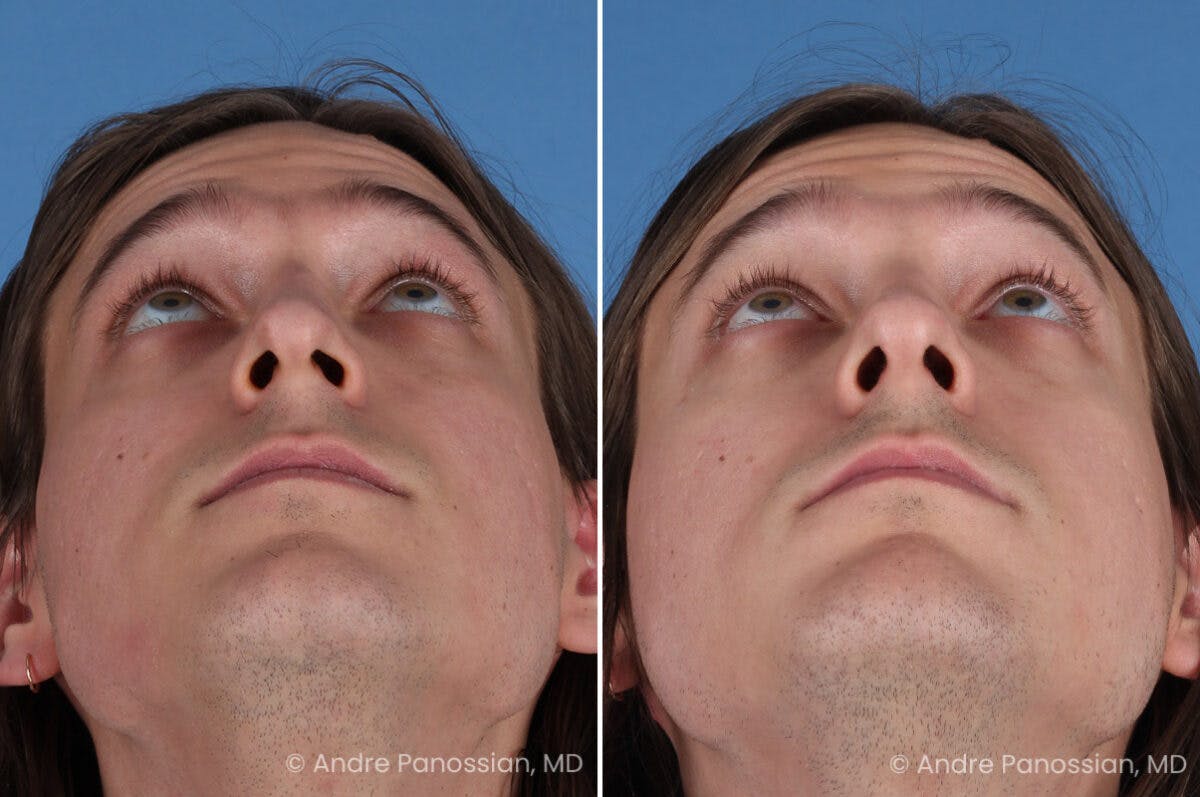 Rhinoplasty Before & After Gallery - Patient 163652 - Image 8