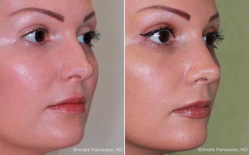 Rhinoplasty Before & After Gallery - Patient 225420 - Image 1