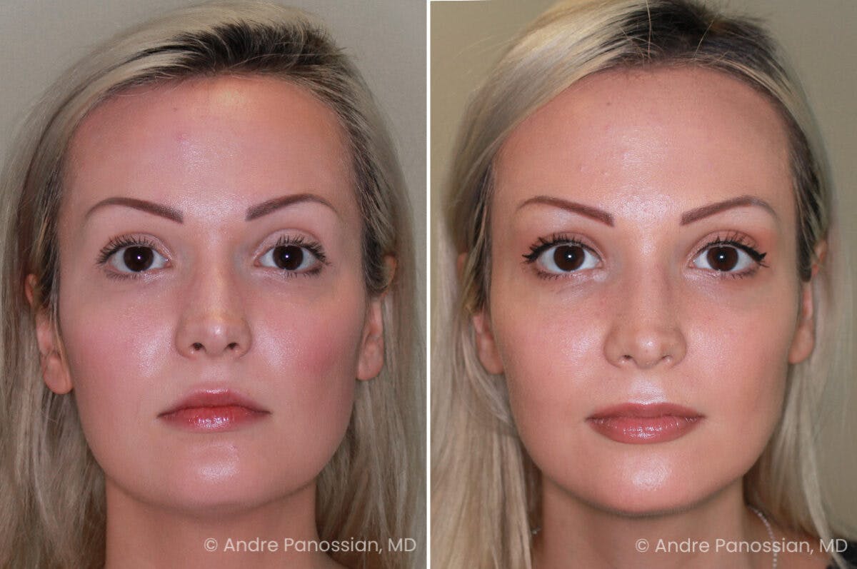 Rhinoplasty Before & After Gallery - Patient 222919 - Image 2