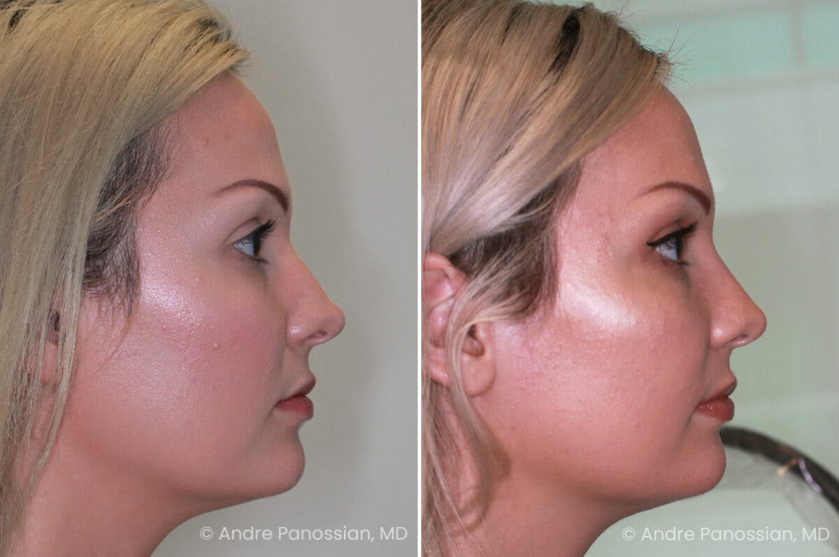 Rhinoplasty Before & After Gallery - Patient 222919 - Image 3