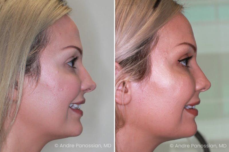 Rhinoplasty Before & After Gallery - Patient 222919 - Image 1