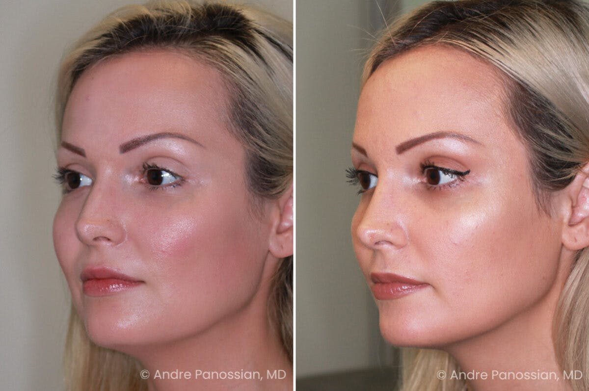Rhinoplasty Before & After Gallery - Patient 222919 - Image 4
