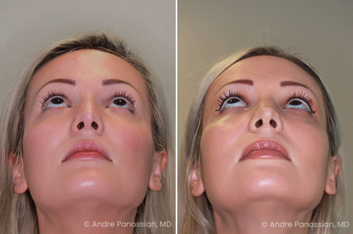 Rhinoplasty Before & After Gallery - Patient 222919 - Image 5