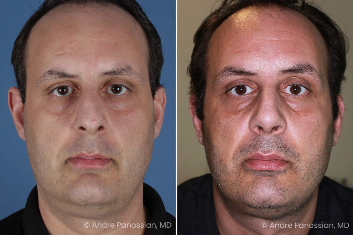 Rhinoplasty Before & After Gallery - Patient 409383 - Image 2