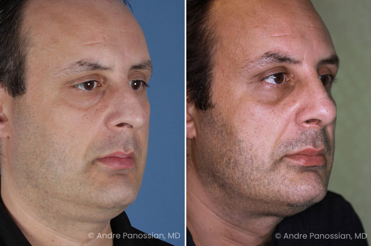 Rhinoplasty Before & After Gallery - Patient 409383 - Image 3