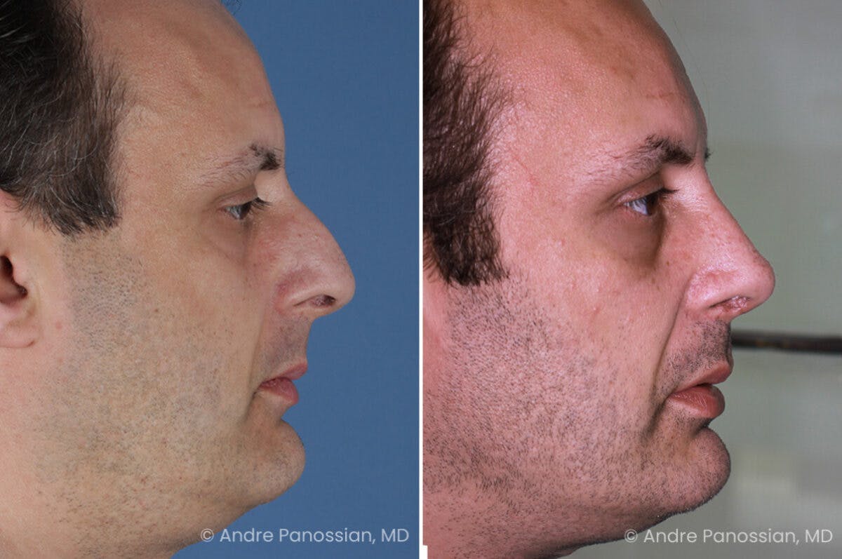 Rhinoplasty Before & After Gallery - Patient 409383 - Image 1