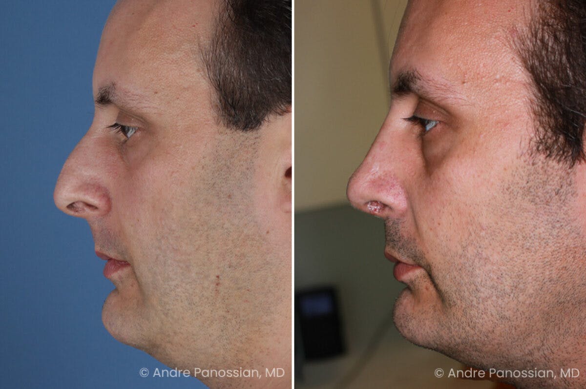 Rhinoplasty Before & After Gallery - Patient 409383 - Image 4