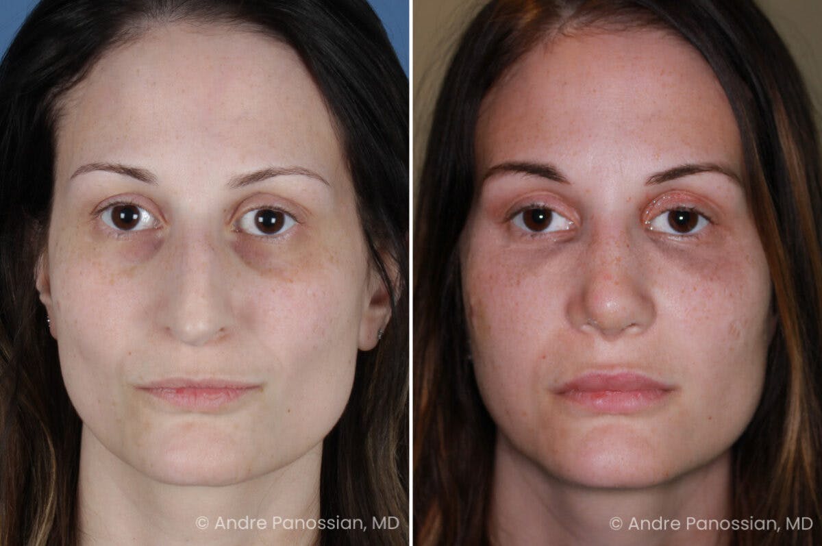 Rhinoplasty Before & After Gallery - Patient 331751 - Image 2