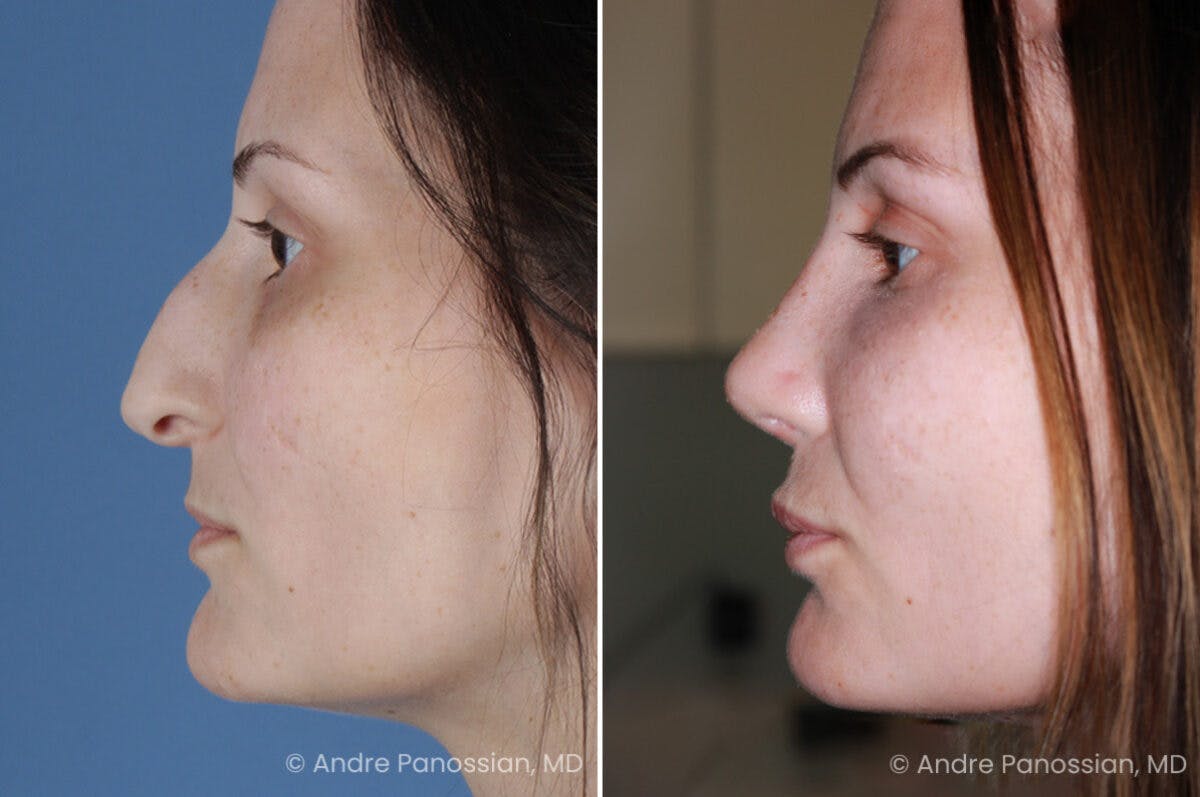 Rhinoplasty Before & After Gallery - Patient 331751 - Image 3