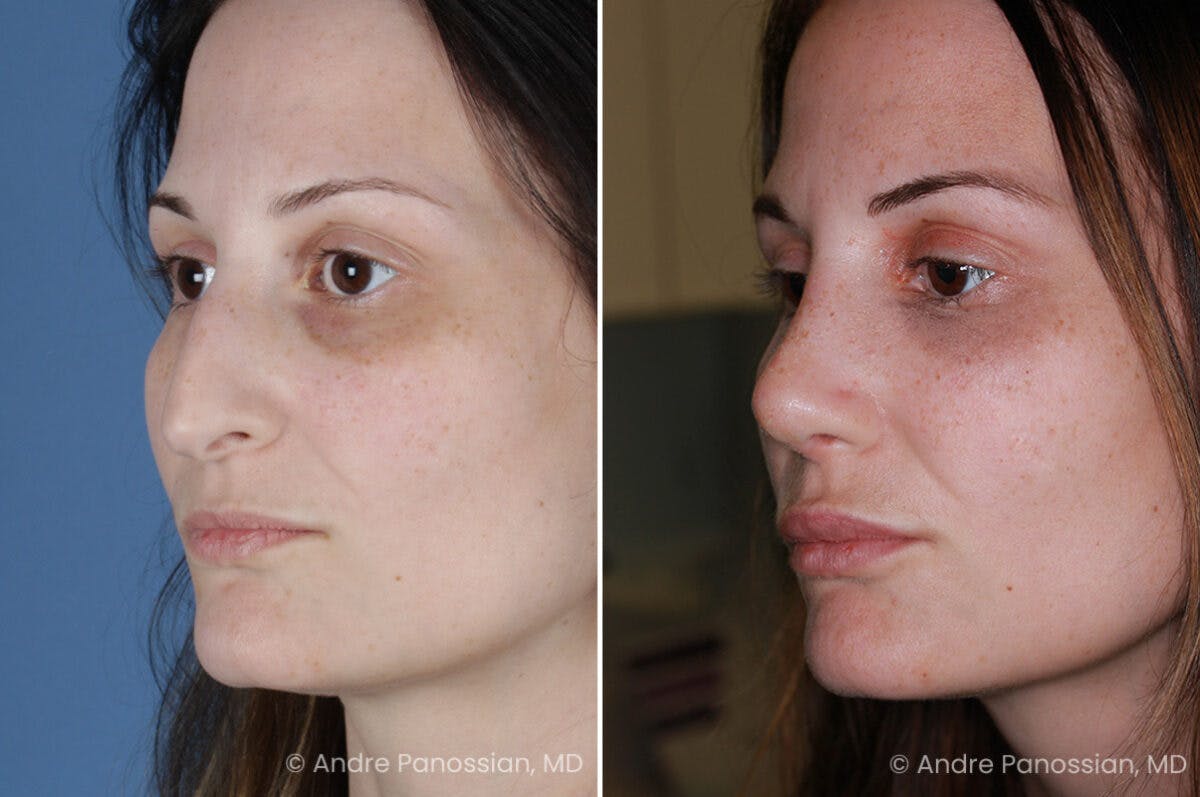 Rhinoplasty Before & After Gallery - Patient 331751 - Image 4