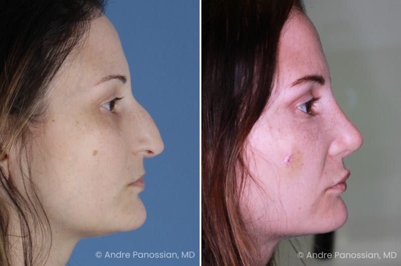 Rhinoplasty Before & After Gallery - Patient 331751 - Image 1